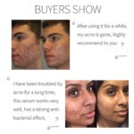 Azelaic Acid 10% Facial Serum 15ml - Image 7