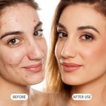 Azelaic Acid Cream 20g - Image 7